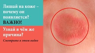 Лишай на коже – почему он появляется ВАЖНО ☞ Смотри в чём причина? Лишай на коже – почему он появляется ВАЖНО ☞ Смотри в чём причина?