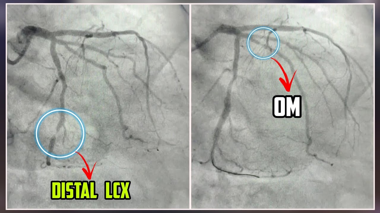 Angioplasty Treatment Double Vessel Stenting ( Distal LCX and OM 😮