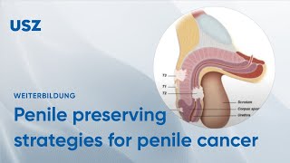 Hpv and penile cancer. Hpv cause penile cancer Hpv and penile cancer statistics