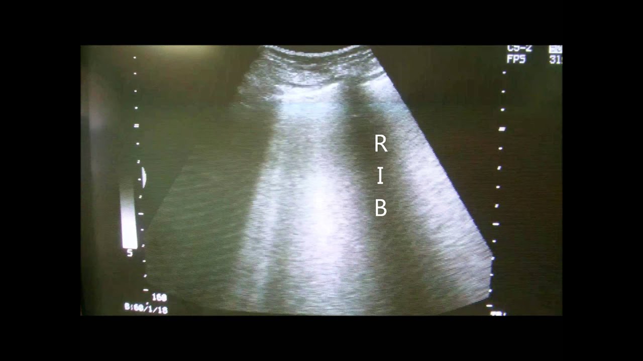 Lung ultrasound of pulmonary edema. - YouTube