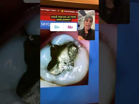 Vídeo: As obturações de amálgama causam rachaduras nos dentes?