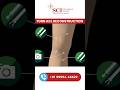 ACL Reconstruction: कैसा किया जाता है? #aclrepair #aclreconstruction #acltear #kneepain