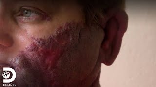Paciente padece enorme mancha facial | Mi cuerpo, mi desafío | Discovery en Español