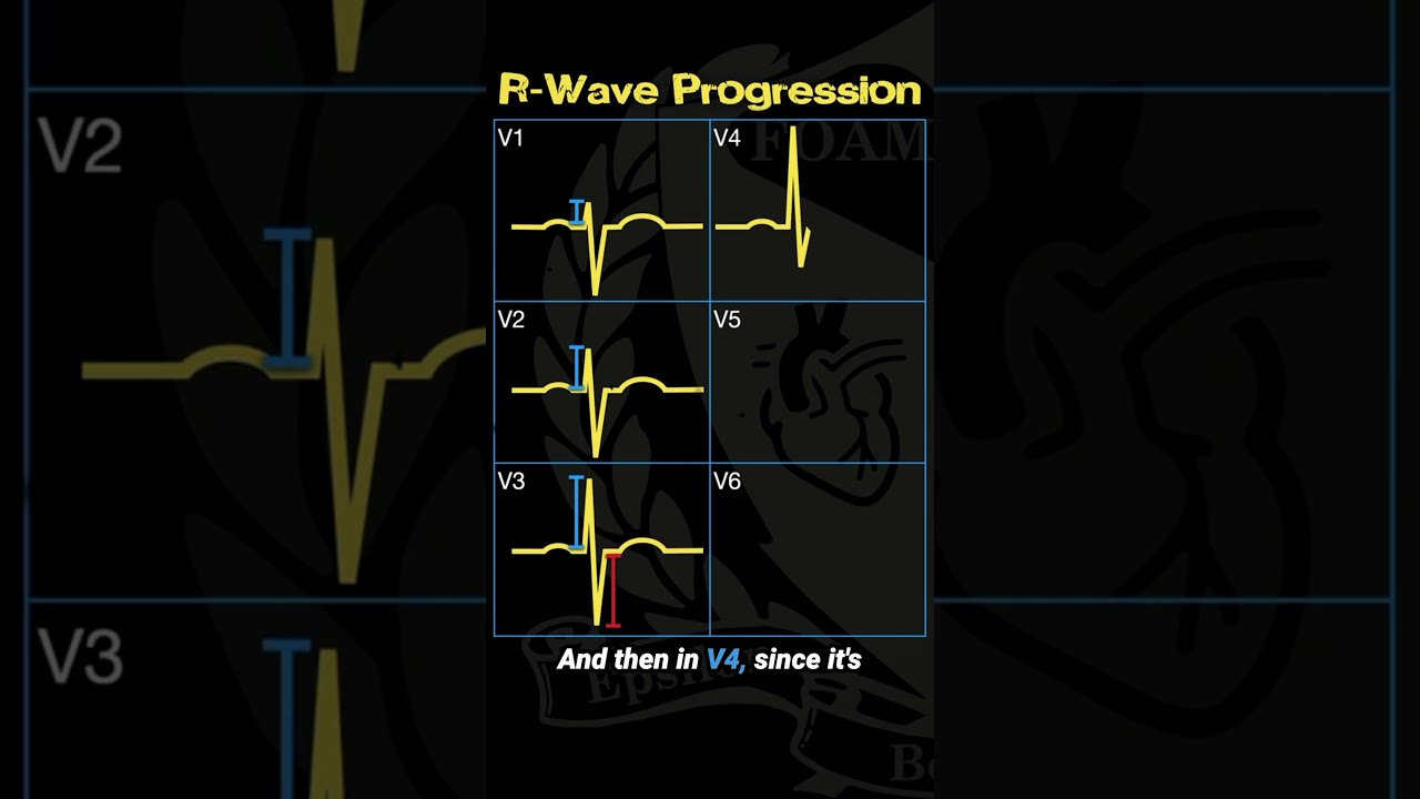 Understanding R Wave Progression