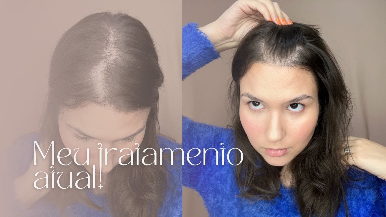 ALOPECIA ANDROGENÉTICA: Meu tratamento atual | Junho 2023