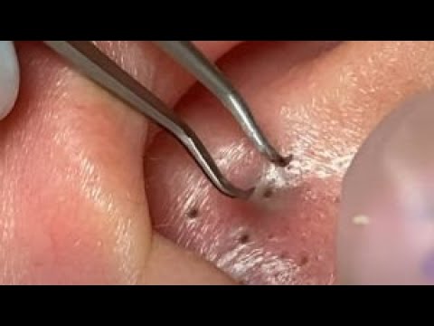 It is so Painful in the EAR big blackheads