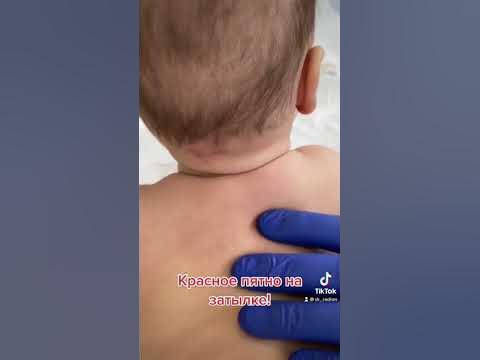 Красное пятно на затылке у грудничка. - YouTube
