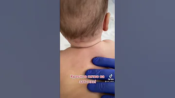 Красное пятно на затылке у грудничка.