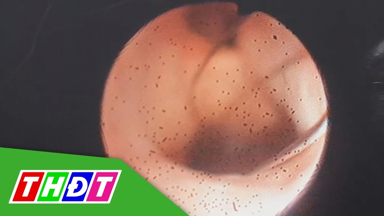 Hàng ngàn con sán lá gan trong ống mật của người đàn ông | THDT