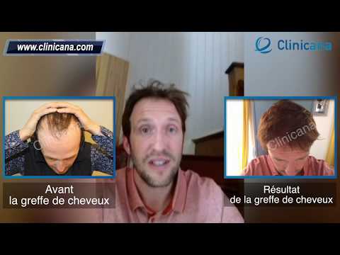Greffe de Cheveux