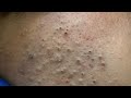Korean Skincare Routine - Blackhead and Pimple Treatment || Deep Pore Cleansing Techniques