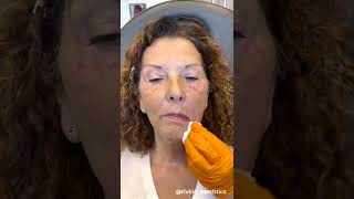 How To Treat Marionette Lines | Westside Aesthetics