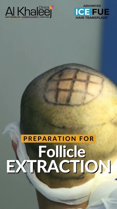 preparation-for-follicle-extraction-ice-fue-hair-transplant-youtube
