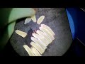 Oblique Split Technique for Rib Graft Carving