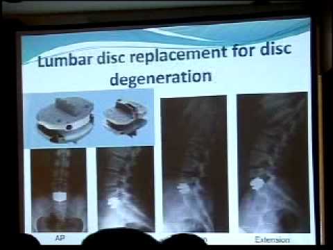 Indications of Surgery in Back Pain - Spine Surgeon's View ...