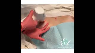 Laser Fractional Treatment for Scar Removal