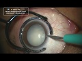 Chirurgie de la cataracte sans sutures par ultrasons  phacoemulsification