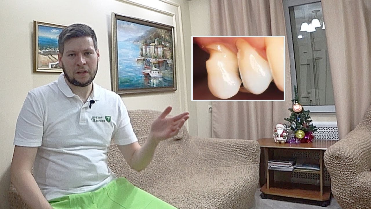 Клиновидный дефект | Пришеечный скол эмали | Абфракция - YouTube