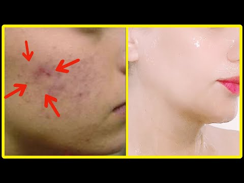 In Just 3 Days How We Got Rid of Acne Scars,Pimples - (100% Works) With Results