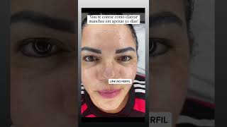 Saiba como clarear manchas e melasma em 30 dias clica no link do primeiro comentário fixador.