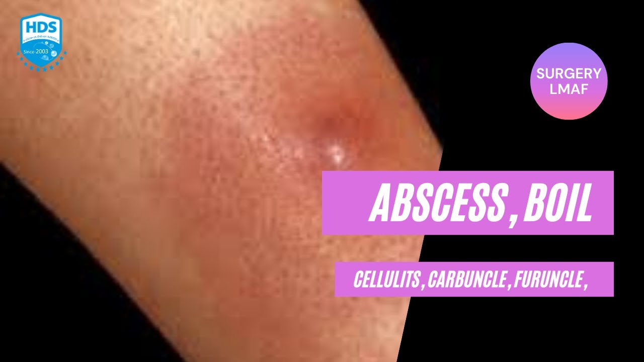 Abscess, Carbuncle, Boil, Furuncle & Cellulitis YouTube