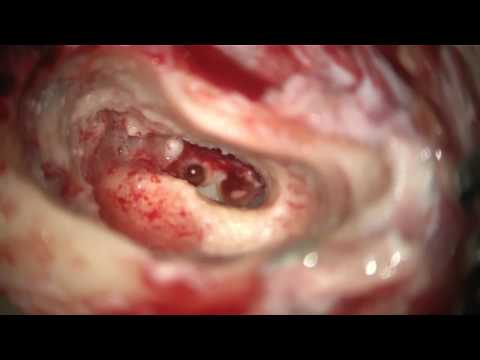 Video: Cochlear Labyrinth: N Anatomia, Toiminta Ja Kaavio - Vartalokartat