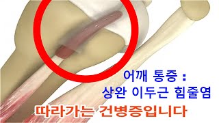 어깨 통증 : 상완 이두근 힘줄염