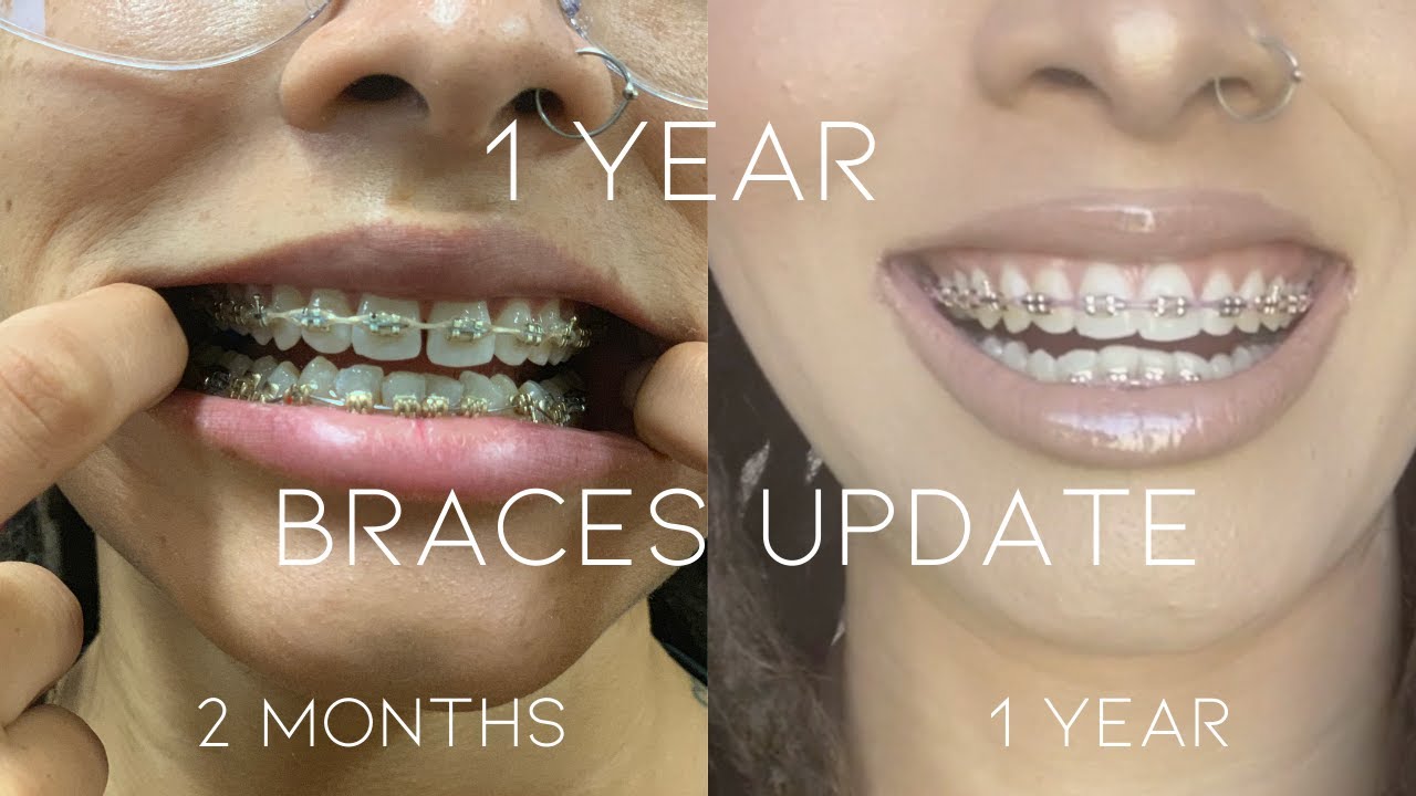 1 Year Of Gold Braces Update Partial Power Chains New Band Color 1 Year Of Gold Braces Update Partial Power Chains New Band Color