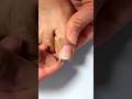 Toe Align Ingrown Nail Corrector Stickers