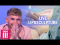 Watching A Live Liposculpture Procedure - Would You Have It Done? | Plastic Surgery Undressed