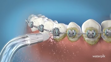 Cách Sử Dụng Đầu Tăm Nước Waterpik Cho Người Niềng Răng