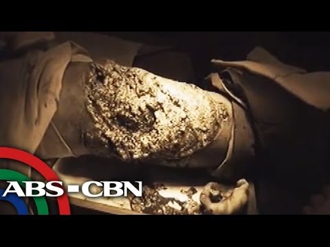 Necrotizing Fasciitis a.k.a. 'Flesh-eating bacteria