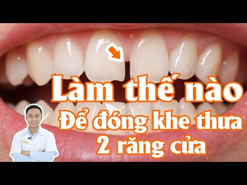 Video: Tại sao các thanh nối có răng cưa?