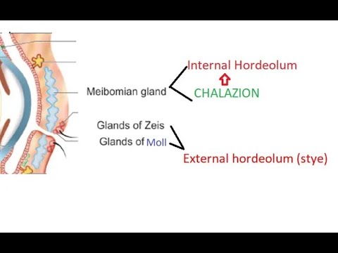 Ophthalmology 375 External hordeolum Stye Chalazion Internal Difference Compare Glands Eyelid eye