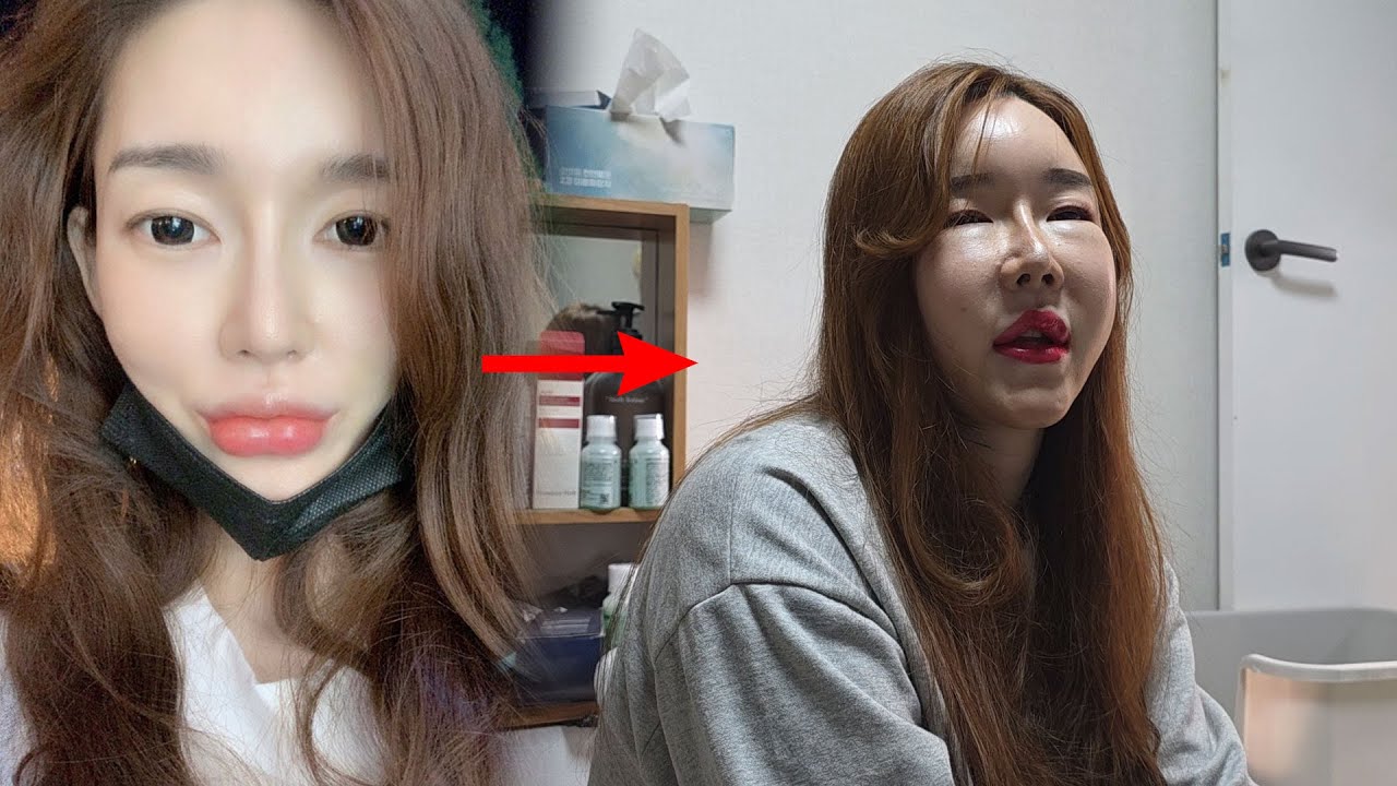 성형중독 트랜스젠더