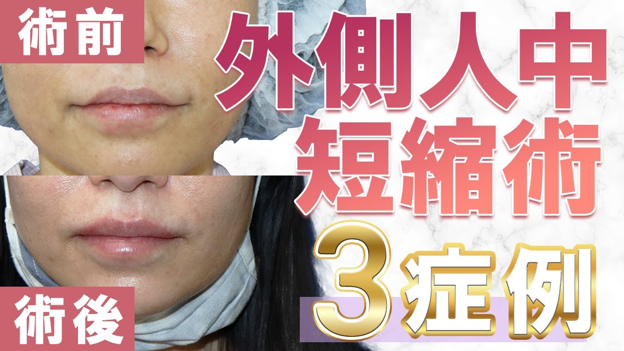 外側人中短縮術（上口唇挙上術）症例@山本クリニック