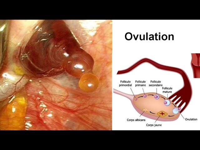 Saignement entre les Règles - Hémorragie Vaginales - Métrorragies