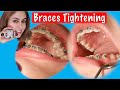 What Happens At Your Braces Adjustment/ Tightening?