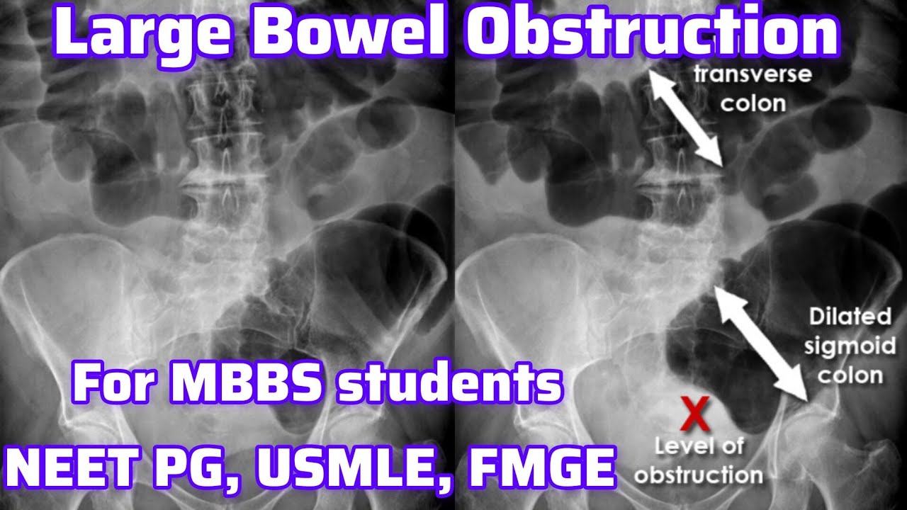 Large Bowel Obstruction For MBBS students, Neet PG, Usmle, FMGE I Neet PG Usmle Preparation