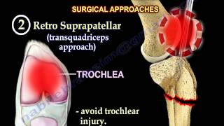 Intramedullary Nailing Proximal Tibial Fractures - Everything You Need To Know - Dr. Nabil Ebraheim