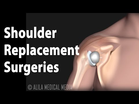 Surgical Options for Shoulder Arthritis, Animation.