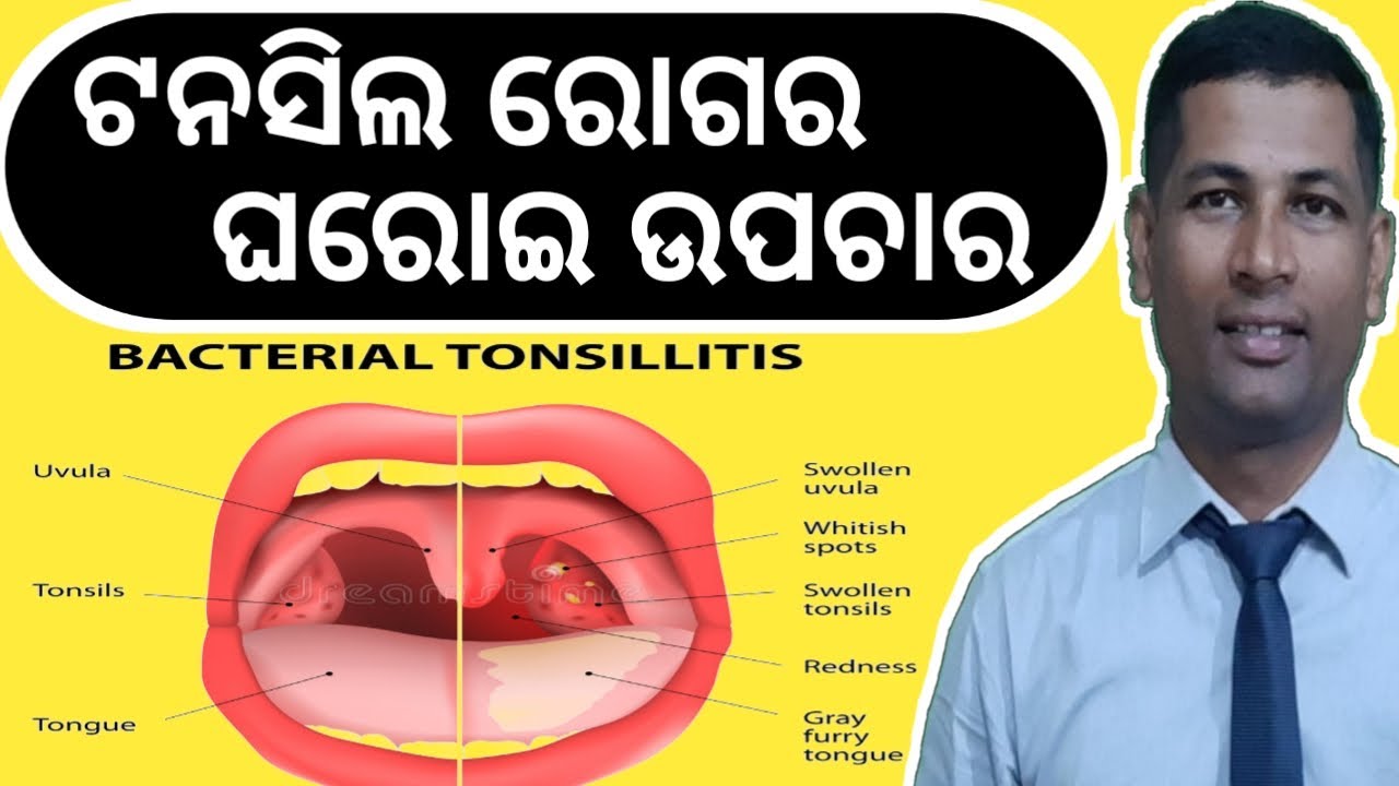 Tonsils Treatment | Tonsillitis Natural Home Remedies | How to Care Tonsillitis | hasi haseiba |