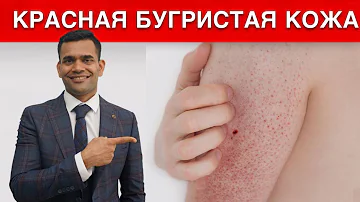 Эффективное Лечение Гусиной кожи / Фолликулярный Кератоз