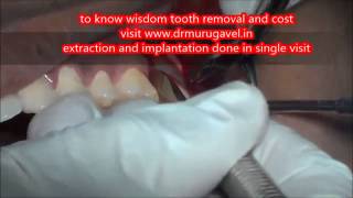 ⁣Upper Wisdom tooth Surgical removal in Best Dental center,Chennai