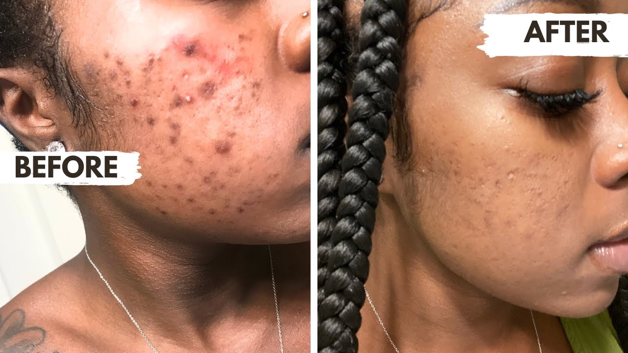 HOW I GOT RID OF MY CONSTANT CYSTIC ACNE & DARK SPOTS! PILLS? TEAS