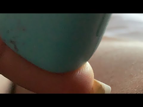 diabetes-and-hair-loss