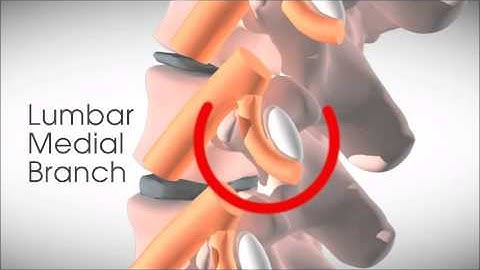 Lumbar medial branch injection