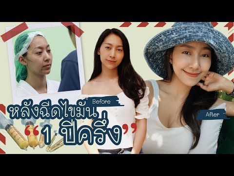 หลังฉีดไขมันหน้า 1 ปีครึ่ง ยุบไม่ยุบ ดีไม่ดี มาดูกัน! l Maybedong