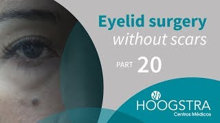 Eyelid surgery without scars - Part 20