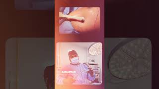 Gynecomastia with Bodytite procedure?